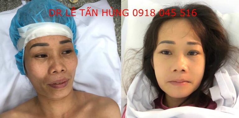 Hình ảnh Bệnh Nhân Trước Và Sau Khi Phẩu Thuật Hàm Hô Móm Thẩm Mỹ